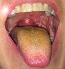 Image result for yellow tongue infection