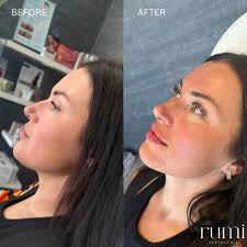 Can anyone recommend anywhere local for anti-wrinkle/aesthetics?