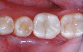 How much does a krown application cost? Immediate Implant Placement In The Molar Region With An Alternative Osteotomy Approach For Org