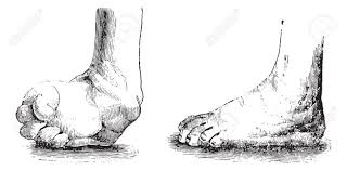Approximately 50% of cases of clubfoot affect both feet. Clubfoot Or Club Foot Or Congenital Talipes Equinovarus Ctev Royalty Free Cliparts Vectors And Stock Illustration Image 35098741