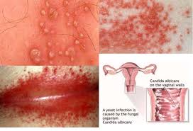 A lot of things can throw off the vagina's bacterial harmony like this and cause a yeast infection. What Does S Yeast Infection Feel Like Definition Lqzz Cleanprofi66 Ru