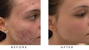 Medical Blue Light Therapy Laser Treatment Pen Usology Trends