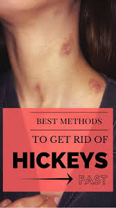 Here Are Best Methods To Get Rid Of Hickeys Fast Get Rid Of Hickies Hickeys How To Get Rid