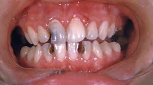 But some can be harmful such as those that play a role in the tooth decay process. Pictures Of Common Dental Problems American Dental Association