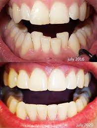 Please note that this sub is for patients, so you won't really find professional help here. Braces Came Off Today Updated The Before And After Pic To Include My Brace Free Teeth Braces