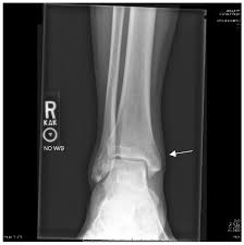 Bilateral Achilles Tendon Rupture: A Case Report and Review of the  Literature