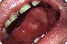 Image result for Mouth ulcers roof of mouth