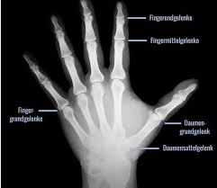 Die arthrose im finger ist eine verschleiß erscheinung. Arthrose In Den Fingern Ursachen Symptome Therapie Lyprinol De