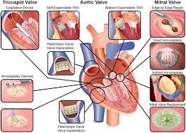 Transcatheter Heart Valve Interventions Where Are We Where Are We Going Heart Valves Mitral Valve Disease Aortic Valve Replacement