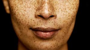 Image result for Freckled skin