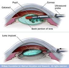 Might Cataract Surgery Be A Cause Of Retinal Detachment Cataract Eye Surgery Cataract Surgery