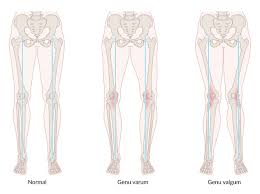 Image result for Genu Varum