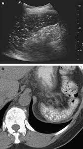Abdominal Manifestations Of Systemic Lupus Erythematosus Spectrum Of Imaging Findings Sciencedirect