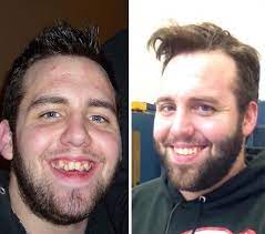 While braces are typically considered the best way to straighten teeth, not everyone likes the metallic look of traditional braces. 114 Incredible Before After Transformations Of People Who Wore Braces Bored Panda