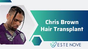 Chris brown premiered a new hairstyle at the 2019 iheartradio music awards. Chris Brown Hair Transplant Estenove Hair Transplant