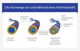 Asthma Bei Kindern Euroclinix