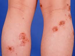 Image result for Eczema nummulare