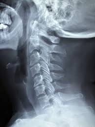 5 Natural Treatments For Degenerative Disc Disease Chiropractor Miami On The Go Wellness