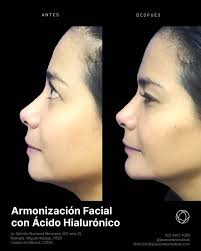 La armonización facial con ácido hialurónico equilibra tus facciones,  suaviza líneas de expresión y devuelve vitalidad a tu piel. 📲 Agenda tu  cita de valoración hoy mismo vía el siguiente número: (55)