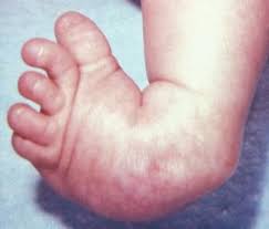 But the condition may be passed down through families in some cases. Clubfoot Causes And Treatments