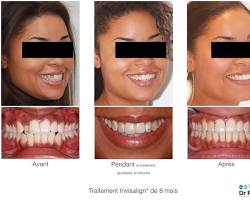 Image de Avantaprès un traitement orthodontique