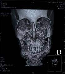 A collection of disease information resources and questions answered by our genetic and rare diseases information specialists for cherubism. Cherubism Wikipedia
