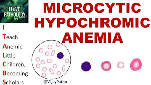 Image result for Microcytic Anemia