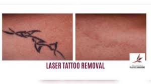 After all most of us would like to today, laser tattoo removal is the most popular way to remove a tattoo. Oklahoma Tattoo Removal Oklahoma Surgeon Offering Free Removal Of Hate Related Tattoos
