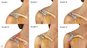 Pin On Sternoclavicular Dislokation