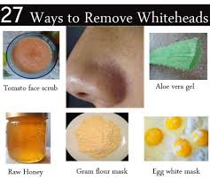 How do i get rid of whiteheads. How To Get Rid Of Whiteheads On Nose At Home 27 Methods Included Skin Disease Remedies