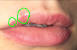 White Head Pimple On Lip
