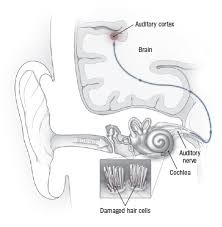 Maybe you would like to learn more about one of these? Tinnitus What To Do About Ringing In The Ears Harvard Health