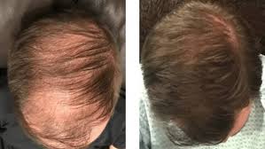 Alternatively, if your hormone levels are too high, you may experience symptoms such as weight loss, hyperactivity or diarrhoea. What Is The Best Treatment For Hair Loss Quora