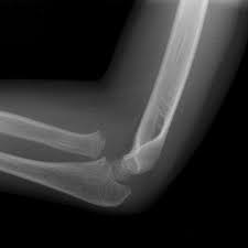 Image result for Radial Head Dislocation