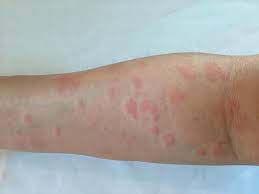 Lupus is an autoimmune disease — meaning the immune system doesn't function properly and attacks a person's own body by mistake — and it affects multiple organs throughout the body. How Lupus Affects The Skin Hines Dermatology Associates Inc Dermatology