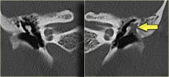 Image result for Ossicular Chain Disruption