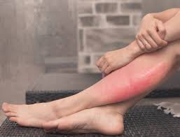 Antibiotic inactive in vitro (or=4.2) and cellulitis severity (or=3.7). Cellulitis Treatment First Signs Of Cellulitis Mvp Pediatric Urgent Care