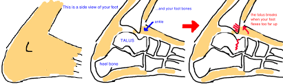 The talus bone or ankle bone is the second largest bone in the foot after the calcaneous or heel bone. Broken Foot Talus Fracture Bone Talks