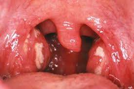 They're smelly, little white globs of who knows what that get built up in the, well, pockets of tonsils. Tonsillitis Nhs