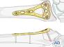 Distal Radius Volar Rim Plate from surgeryreference.aofoundation.org