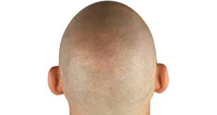 Circa un terzo della popolazione mondiale, infatti, pare essere affetta da calvizie in modo più o meno grave già tra i 12 e i 20 anni. Cauta Dei Capelli I Tipi Di Alopecia E Come Intervenire Per Contenerla