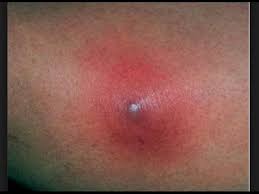 Perban buah ara kering yang dipipihkan ditaruh pada bisul memautkan yang diderita oleh raja hizkia. Sering Makan Telur Bisa Menyebabkan Bisul Ini Penjelasannya