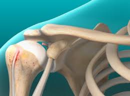 Two separate tendons (tendons attach muscles to bones) connect the upper part of the biceps muscle to the shoulder. Biceps Tendon Tear At The Shoulder