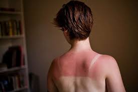 Coup de soleil avec cloques. Coups De Soleil Le Mecanisme Vient D Etre Elucide