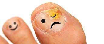 Oct 30, 2017 · depending on which toenail fell off, it can take anywhere from six months to two years for the nail to completely grow back. What To Do When Your Toenail Is Falling Off Advanced Foot Care