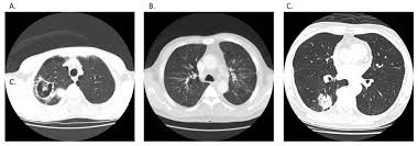 Lung cancer and pulmonary tuberculosis (tb) comorbidity is a clinical problem that presents a challenge for the diagnosis and treatment of both diseases.objective: Jcm Free Full Text Factors For The Early Revision Of Misdiagnosed Tuberculosis To Lung Cancer A Multicenter Study In A Tuberculosis Prevalent Area Html