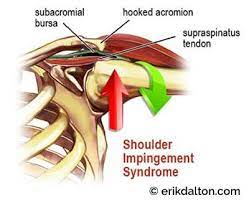 Impingement Syndrome Shoulder