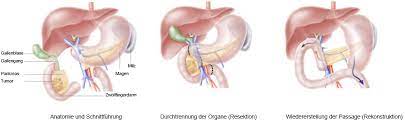 Bauchspeicheldrusenkrebs Behandlung Universitatsspital Zurich