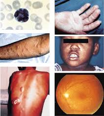 Image result for human t-lymphotropic virus