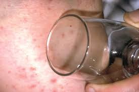 Contact us for a free consultation Rashes In Children The Pharmaceutical Journal